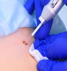 Wart Removal